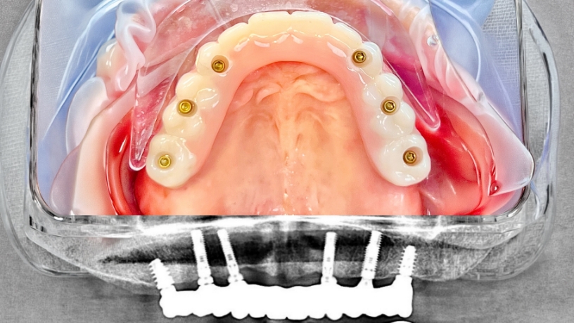 After_Maxilla(Top)_Case3 Andres Hurtado, DDS (1)