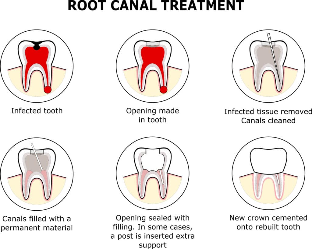 Root,Canal,Treatment,Vector,Illustration