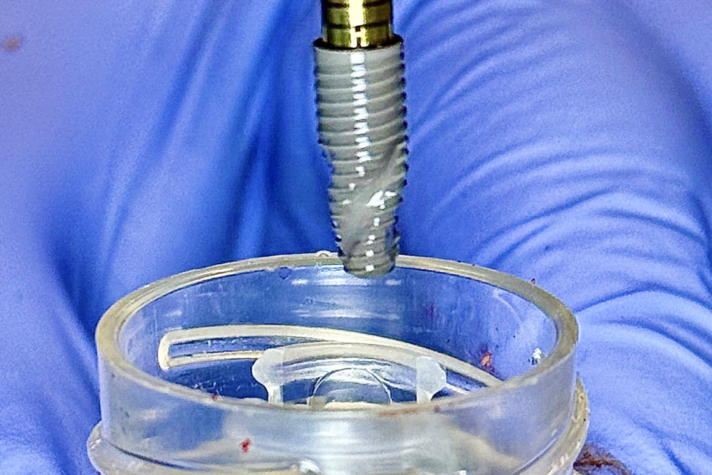 dental-implant